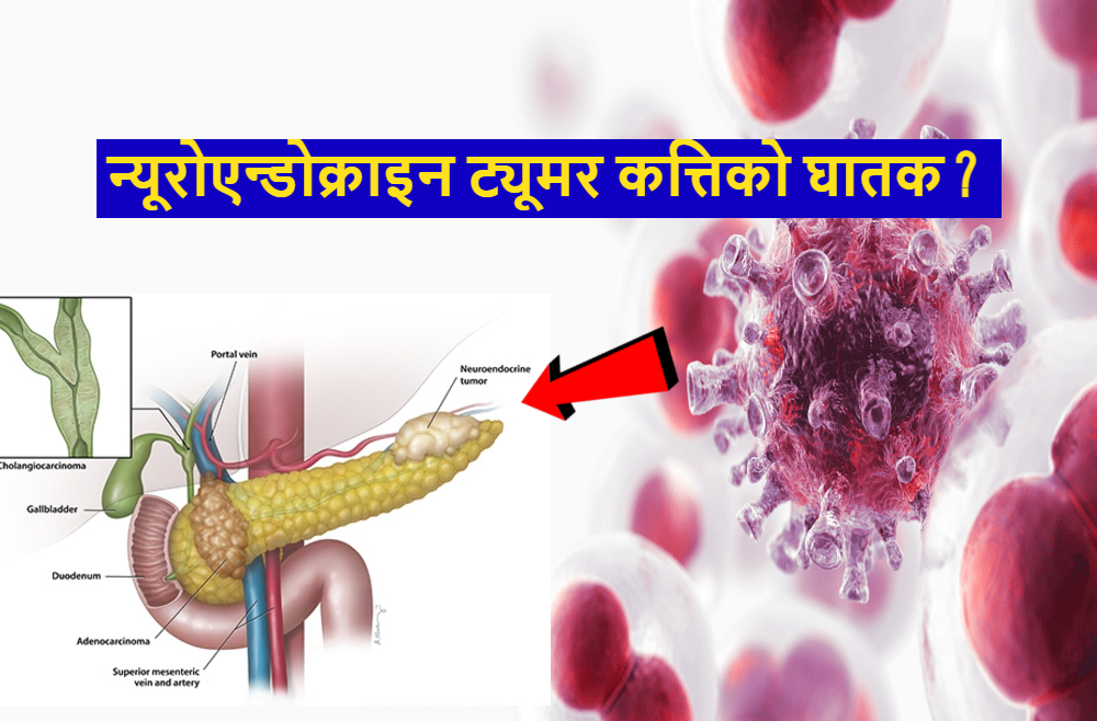 न्यूरोएन्डोक्राइन ट्यूमर के हो, र उपचार कसरी गरिन्छ ?