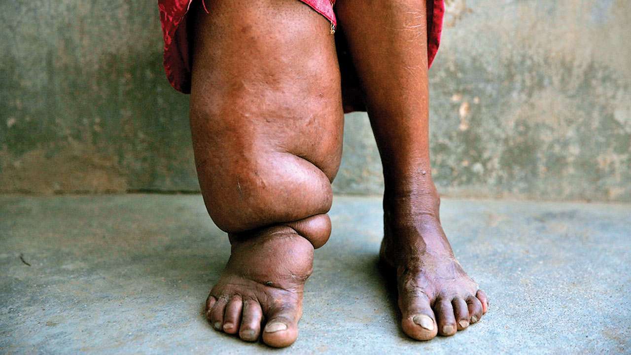 हात्तीपाइले रोगः निवारण चुनौती बन्दै