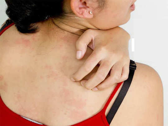 छालासम्बन्धि समस्या ‘लुतो’ र साउने संक्रान्तिको महिमा