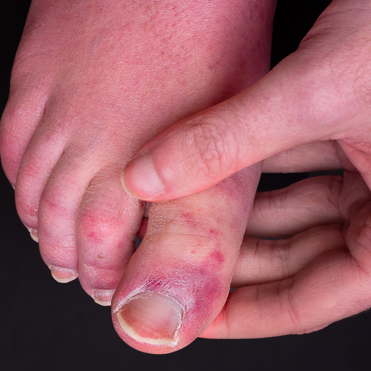 के हो कोभिड टो ? यी हुन् लक्षण