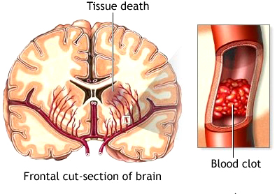 दुई प्रतिशत कोभिड बिरामीमा मस्तिष्कघात !