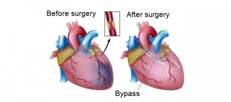 शल्यक्रिया गर्नुपर्ने मुटु रोग
