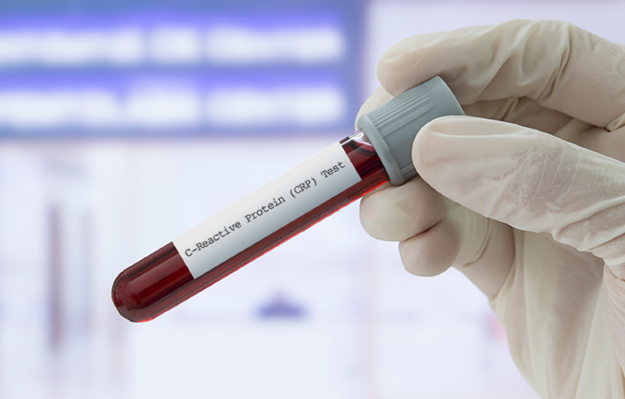 'सी–रियाक्टिभ प्रोटिन' परीक्षणले हृदयाघातबाट हुने मृत्युको जोखिम कम गर्न सहयोग गर्छ: अध्ययन