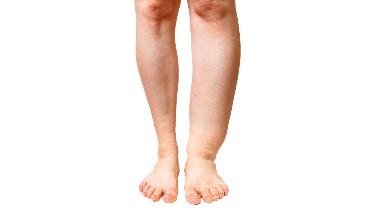 हात्तीपाइले रोगविरुद्धको अभियान सुस्त