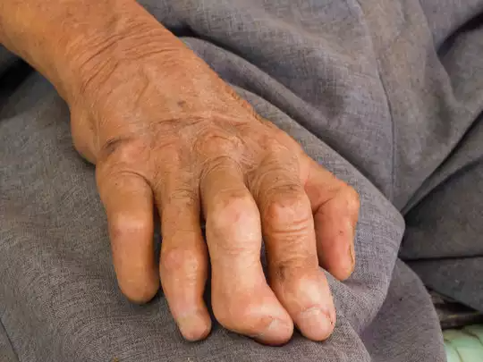 ‘मंकीपक्स’को आशंकामा टेकु अस्पताल भर्ना भएका युवकमा कुष्टरोग पुष्टि