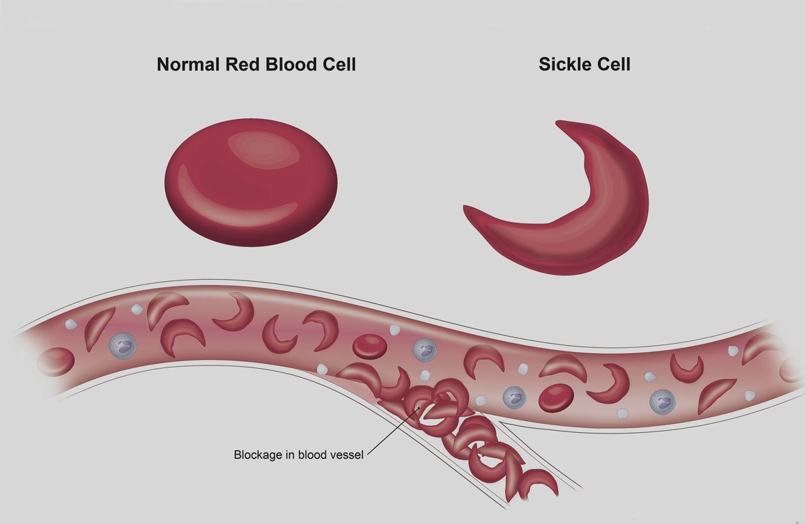 बाँकेमा सिकलसेलका बिरामी बढ्दै