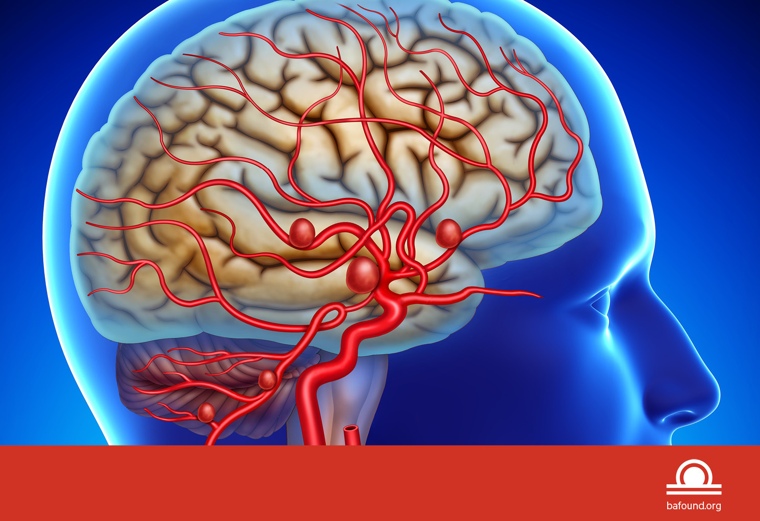 ब्रेन एन्युरिजम: जोखिम वर्ग, उपचारका विधि र सफलता