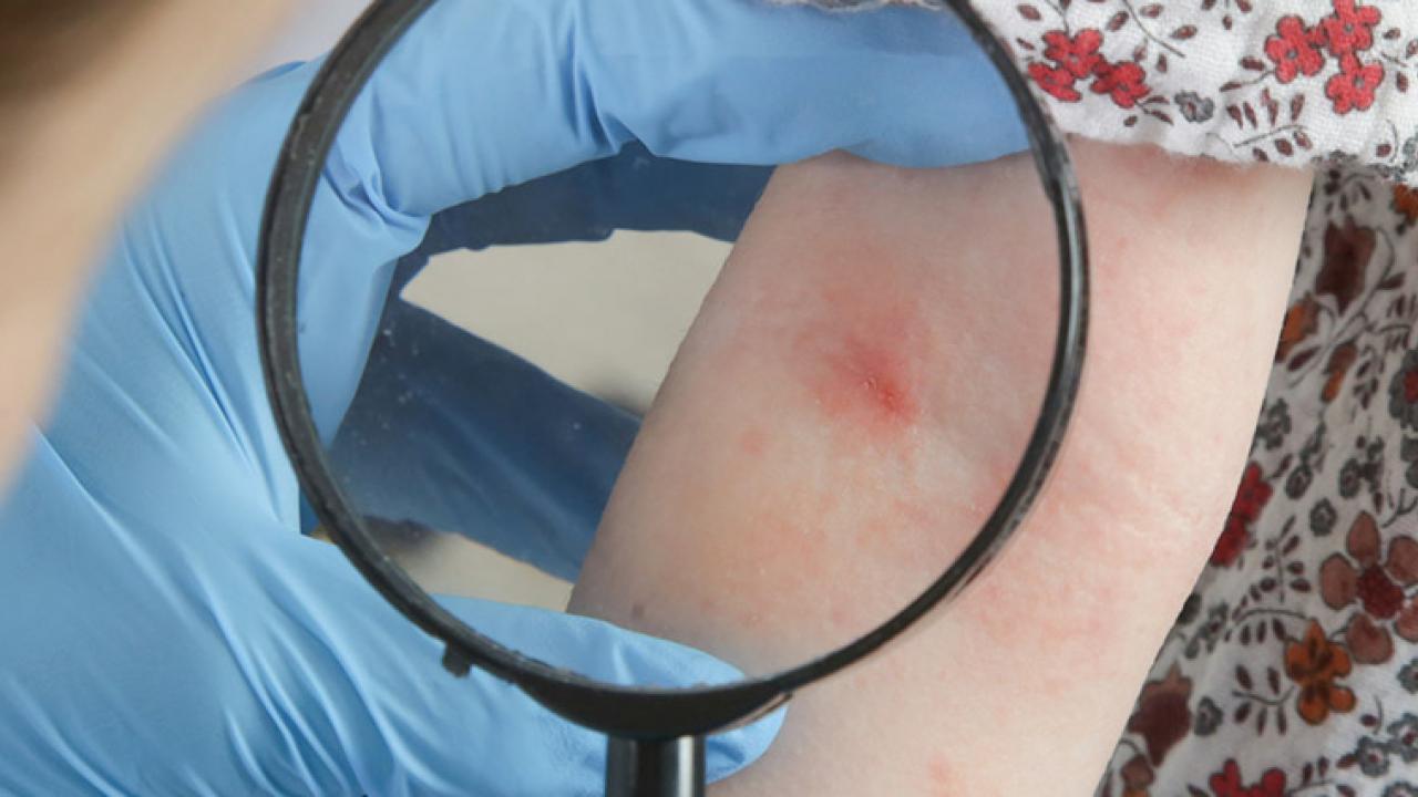 बालबालिकामा हुने छाला रोगहरुको सही निदान र व्यवस्थापन