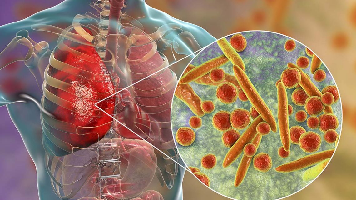 चिसो मौसममा बालबालिका र वृद्धवृद्धामा निमोनियाको जोखिम, यसरी सकिन्छ सजिलै बच्न