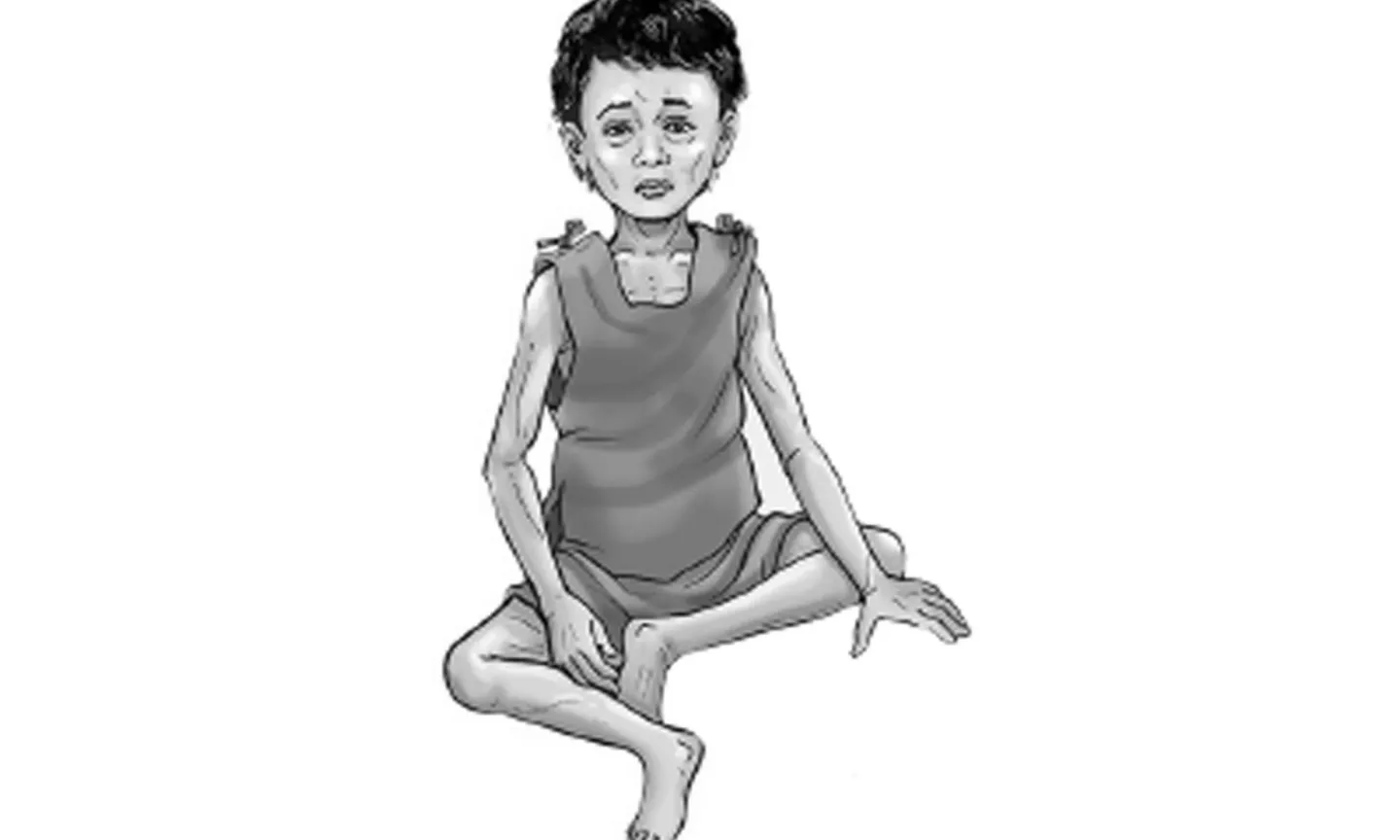 एचआइभी सङ्क्रमितलाई कुपोषणको समस्या