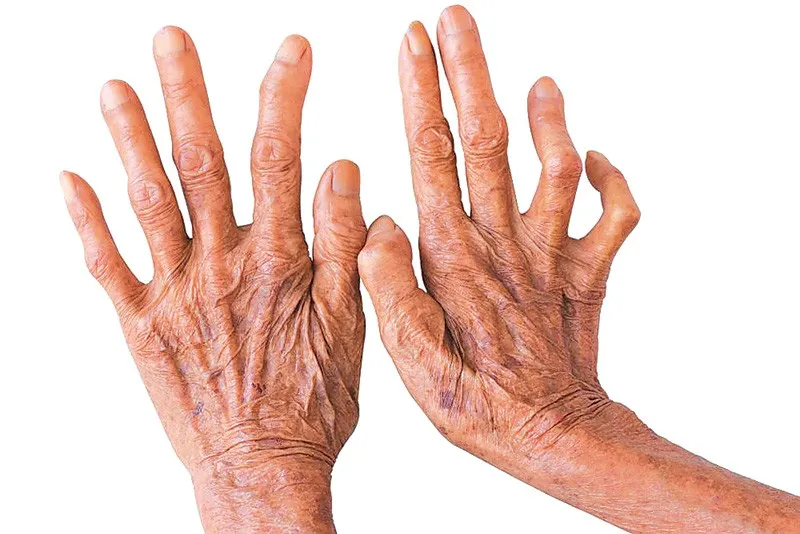 बाँके र बर्दियामा कुष्ठरोग निवारणमा चुनौती