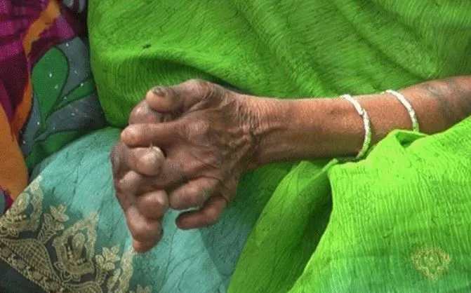 ७०औँ विश्व कुष्ठरोग दिवस : मधेस प्रदेशमा सबैभन्दा धेरै कुष्ठरोगी