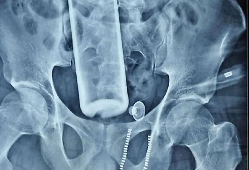 पेटभित्र रक्सीको बोतल पसेको युवकको सफल शल्यक्रिया, स्वास्थ्य अवस्था सामान्य