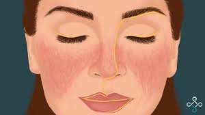 लुपस बाथ : कारण, लक्षण, जटिलता, पहिचान र उपचार