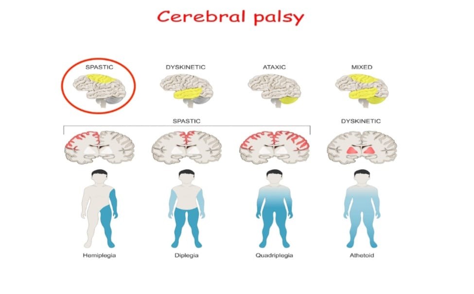 सेरेब्रल पल्सीः चाँडै उपचार पाएमा सामान्य जीवनमा फर्काउन मद्धत