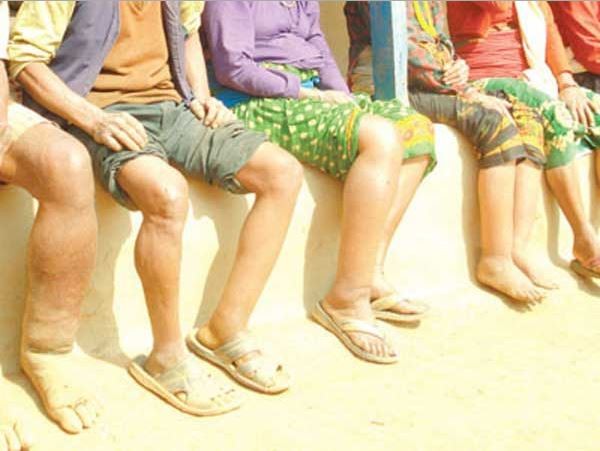 विज्ञ चिकित्सकसहितको टोली गाउँ–गाउँमा पुगेर हात्तीपाइले र हाइड्रोशिलका बिरामीको खोजपड्ताल