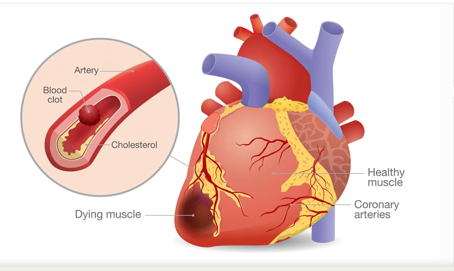 खानपान र जीवनशैलीमा आएको परिवर्तनले युवामा समेत मुटुको समस्या