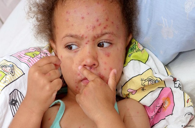 दादुरा–रुवेलाविरुद्धको खोप अभियान आजदेखि, आ-आफ्नो बालबालिकालाई लगाउन अनुरोध, खोपको प्रभावकारिता ८५ प्रतिशतसम्म