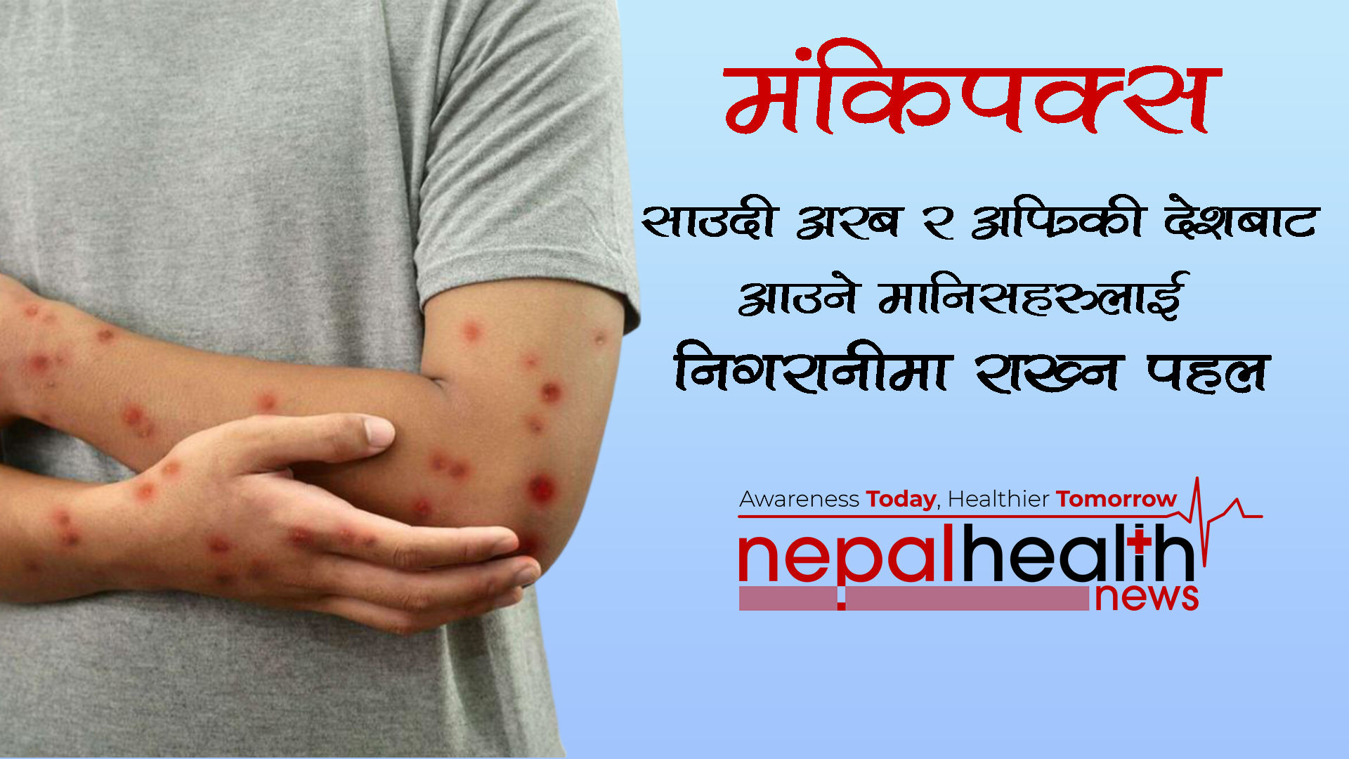 मंकिपक्स निदानका लागि देशभर १४ अस्पताल तोकिए, नाकाहरूमा हेल्थ डेक्सको व्यवस्था