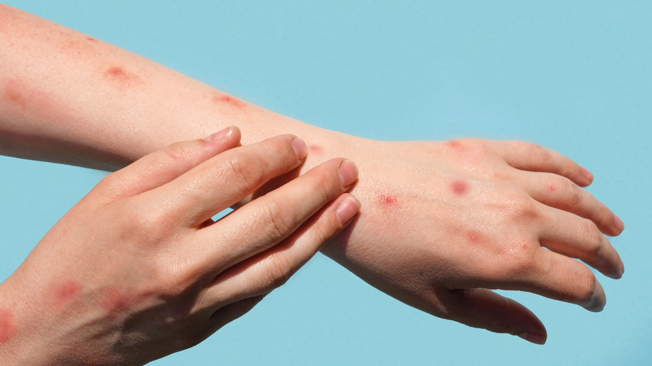 मंकिपक्स समुदायस्तरमा फैलिन नदिन सरकार के गर्दै छ ?