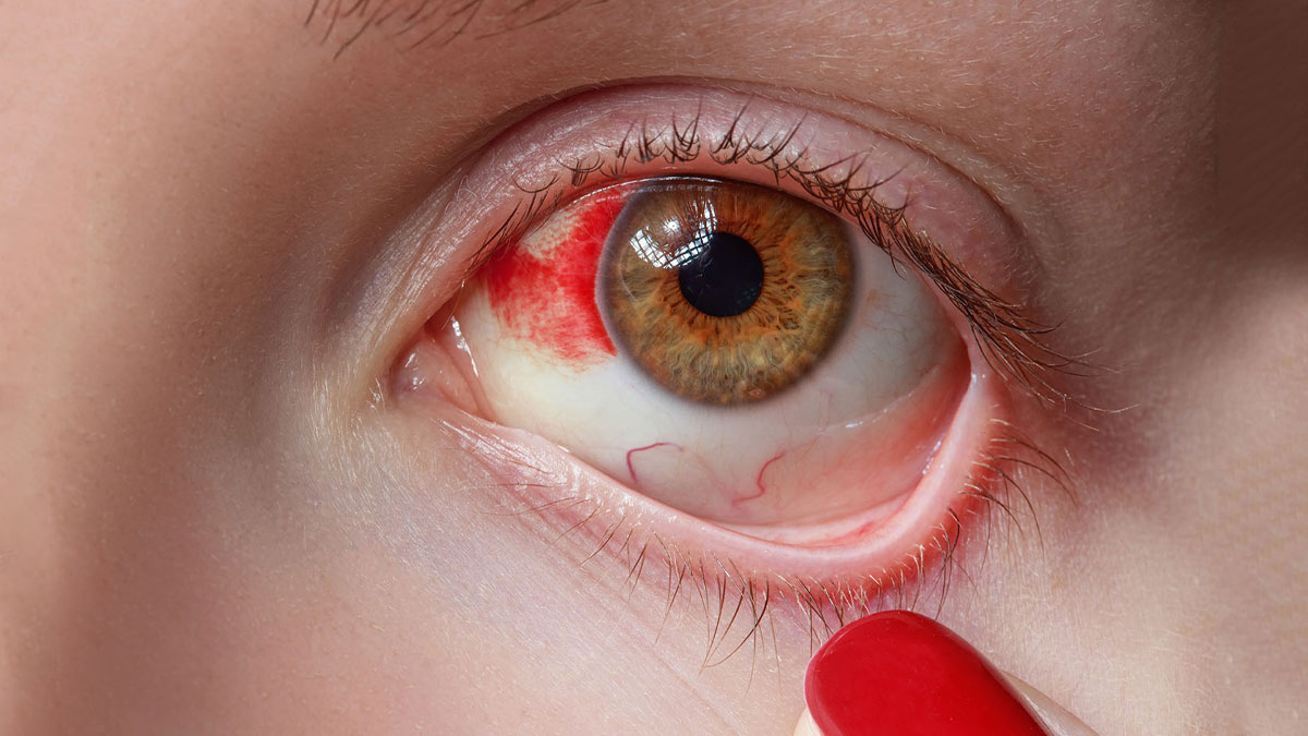 जाडोयाममा किन बढ्छ 'कन्जक्टिभाइटिस' को जोखिमः कारण, लक्षण र बच्ने उपाय ?