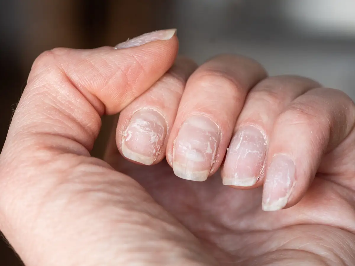 औँलाको नङले तपाईंको स्वास्थ्यबारे के बताउँछ ?