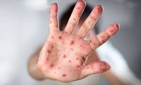 दादुराका ६७ बिरामी उपचारपछि घर फर्किए, २० जना आइसोलेसनमा