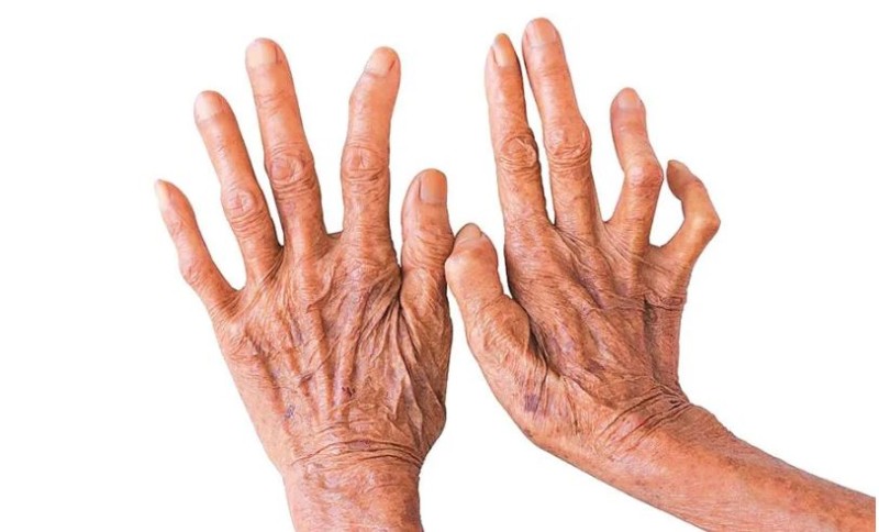 चितवनमा १८ जनामा कुष्ठरोग पुष्टि