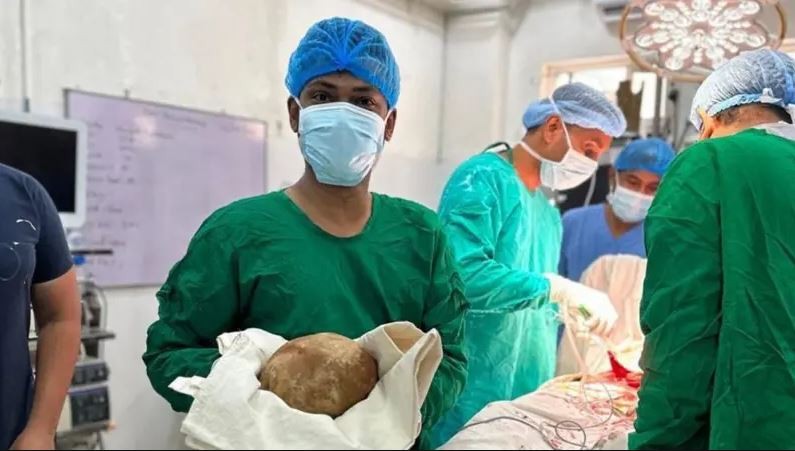 श्रीलङ्कामा ५५ वर्षीय पुरुषको मुत्रथैलीबाट निकालियो ३.१ किलोको पत्थरी