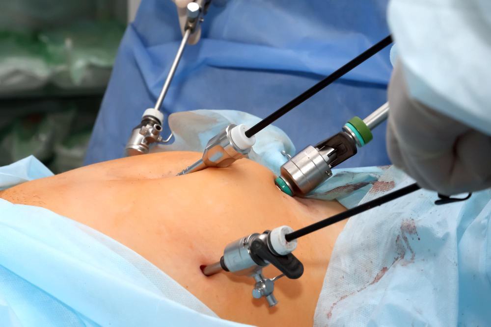 Laparoscopic-Appendectomy-1749720007.jpg