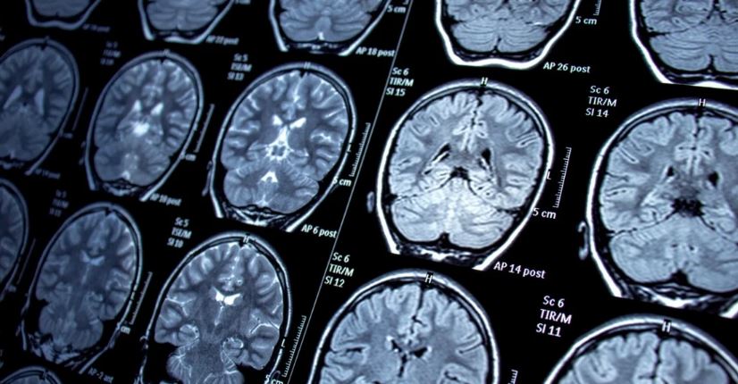 बिरामीको ट्युमर नै गायब पार्ने क्यान्सरको नयाँ इन्जेक्सन परीक्षण सफल