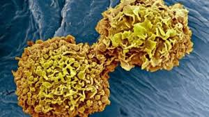 स्तन क्यान्सर पत्ता लगाउन चिकित्सकभन्दा 'एआई' बढी प्रभावकारी