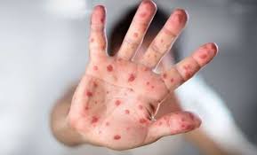 दादुराका ६७ बिरामी उपचारपछि घर फर्किए, २० जना आइसोलेसनमा