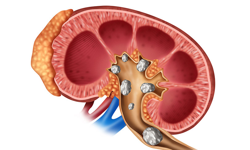 kidney-stones--1793259390.jpg