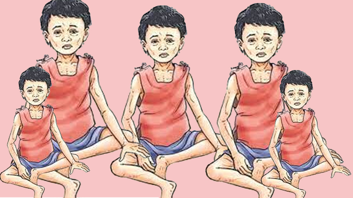 यूएसएआईडी बन्द भएपछि नेपालमा पोषण संकट बढ्दैः दशकौंको प्रगति जोखिममा