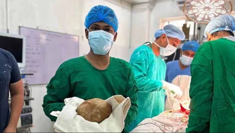 श्रीलङ्कामा ५५ वर्षीय पुरुषको मुत्रथैलीबाट निकालियो ३.१ किलोको पत्थरी